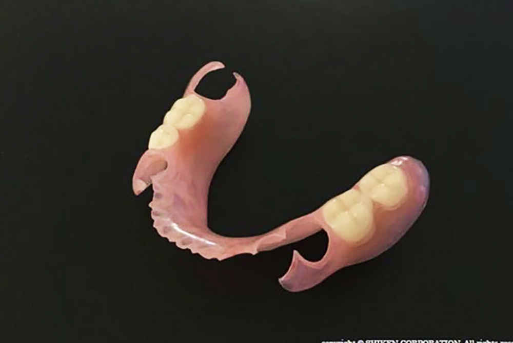 ノンクラスプデンチャー
