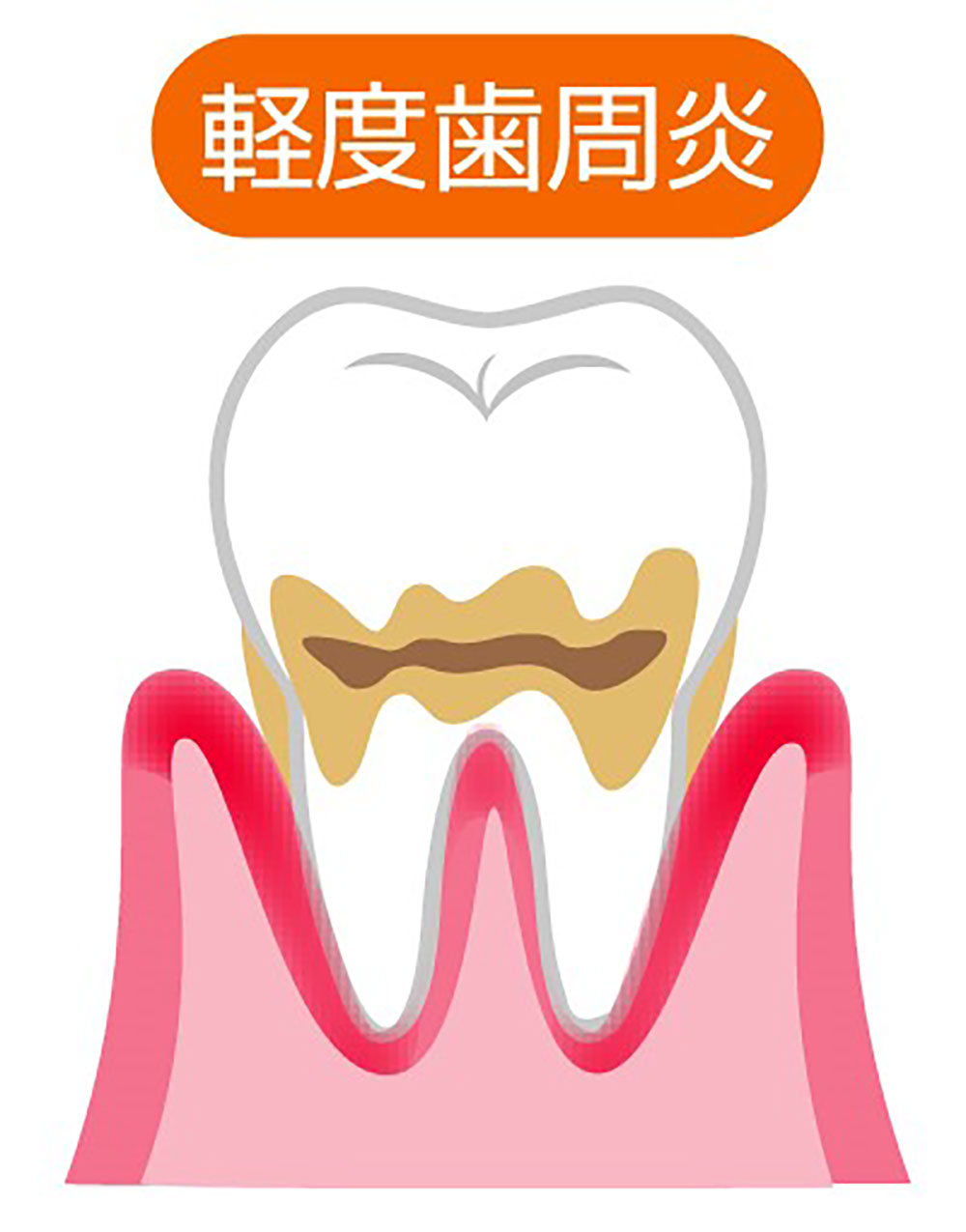 軽度歯周病