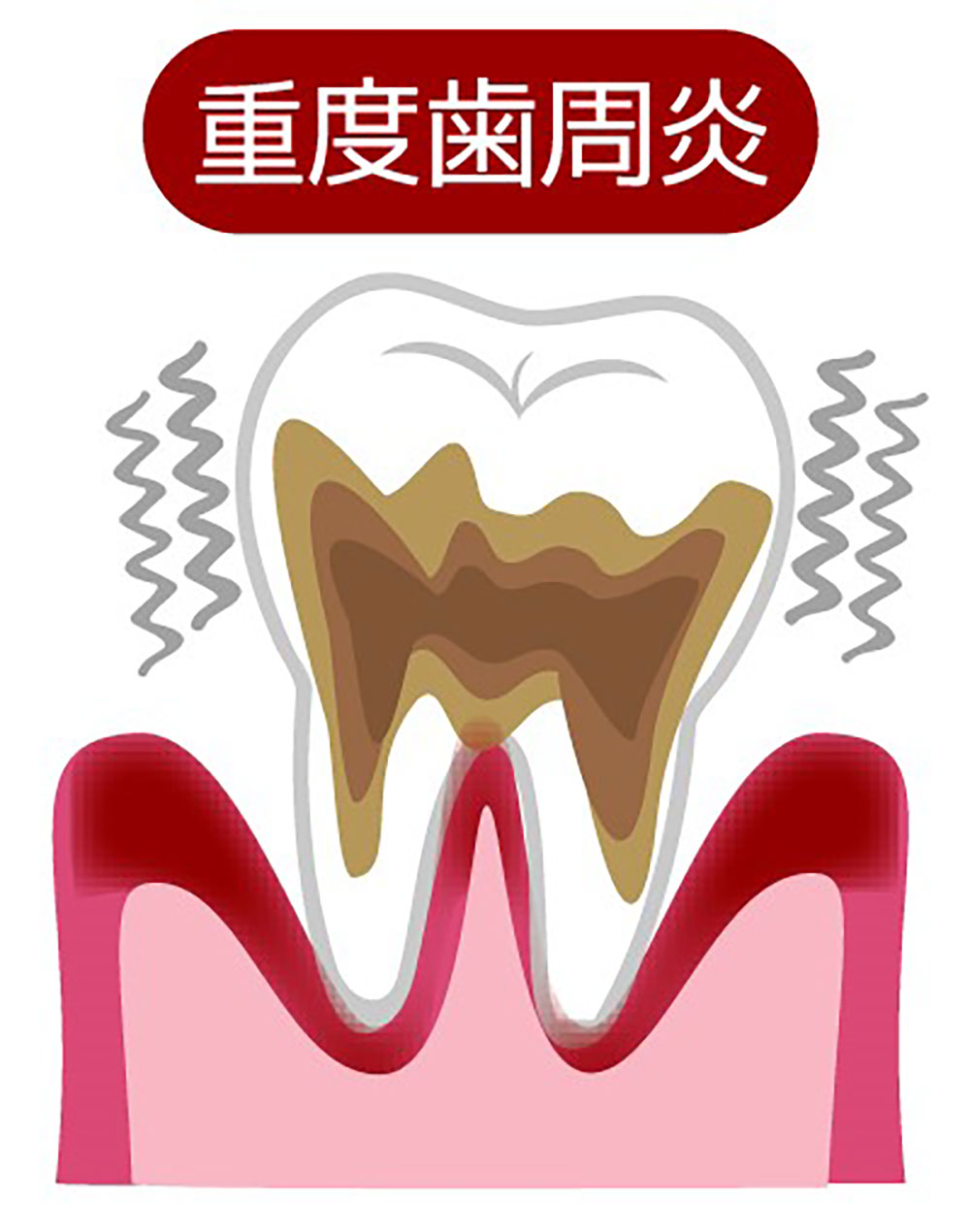 重度歯周病